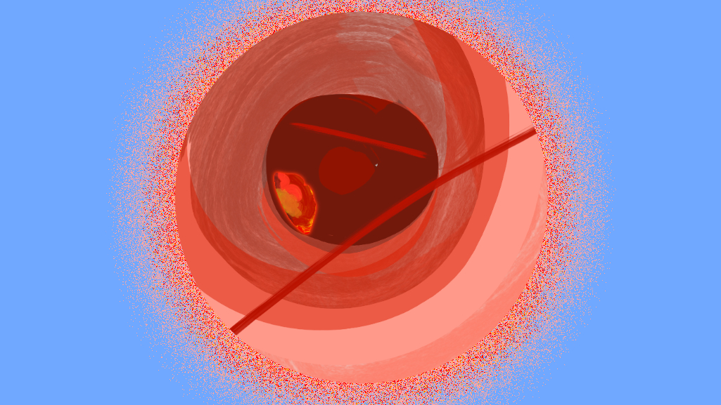 Популярно про гастрити